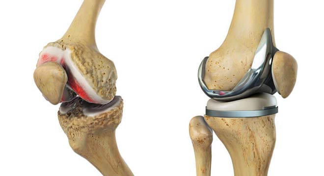 تعويض مفصل زانو